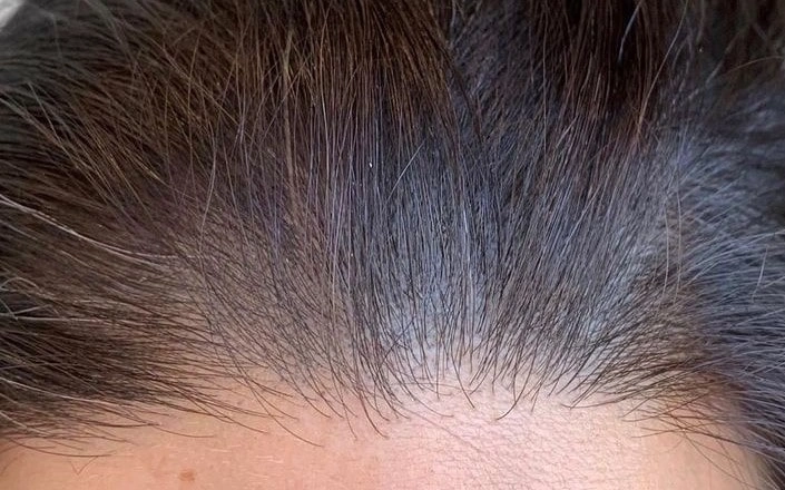 خدمات میکرو اسکالپ سر